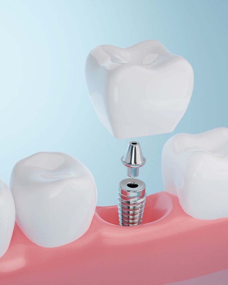 Dental Implants procedure in Huntsville, AL