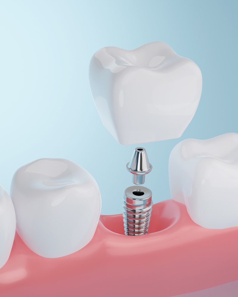 Dental Implants procedure in Madison, AL